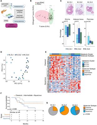 Integrating metabolic profiling of pancreatic juice with transcriptomic analysis of pancreatic cancer tissue identifies distinct clinical subgroups